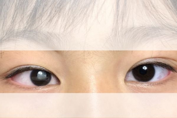 白色瞳孔